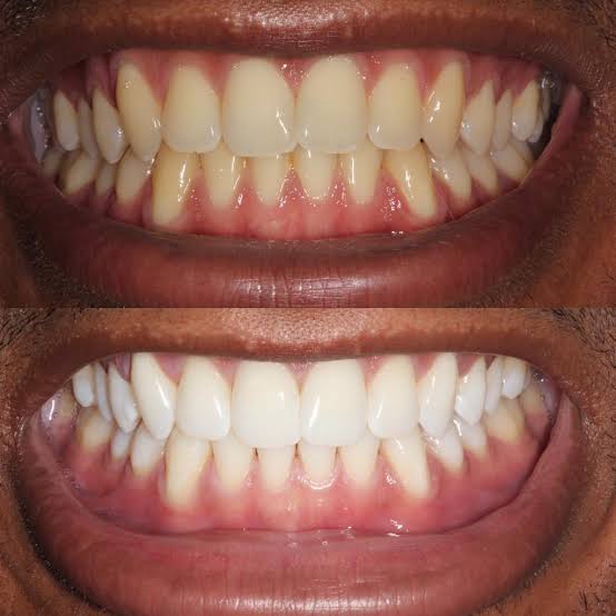 Zayn's Smile Makeover